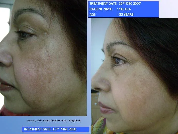 laser fracionado co2 sao paulo osasco alphaville laser fracionado co2 sao paulo osasco alphaville