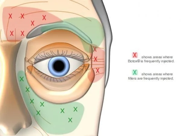areas de aplicacao de botox e de preenchimento