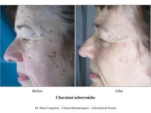 Cuidados aplicação do Laser Fracionado Laser Co2 fracionado