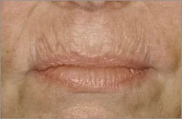 laser fracionado co2 sao paulo osasco alphaville laser fracionado co2 sao paulo osasco alphaville