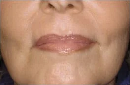 laser fracionado co2 sao paulo osasco alphaville laser fracionado co2 sao paulo osasco alphaville