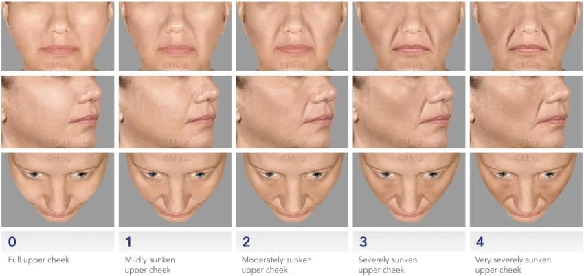 Escala de envelhecimento para preenchimento com restylane ou juvederm ou acido hialuronico