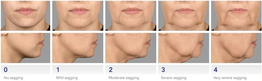 Escala de envelhecimento para preenchimento marionete com restylane ou juvederm ou acido hialuronico