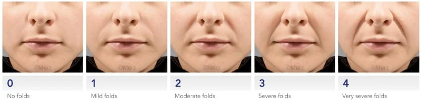 preenchimento bigode chines com acido hialuronico restylane perlane juvederm face sao paulo osasco dermatologista