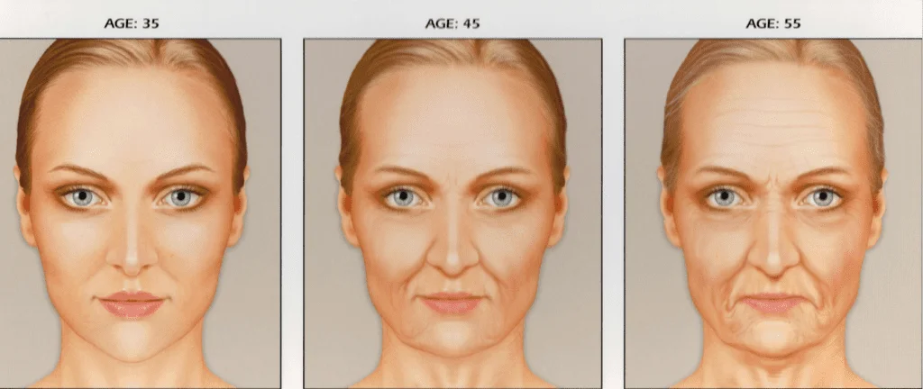 preenchimento-com-acido-hialuronico-restylane-perlane-juvederm-face-sao-paulo-osasco-dermatologista