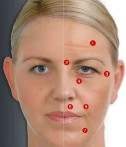 rugas-tratamento preenchimento restylane juvederm radiesse sculptra