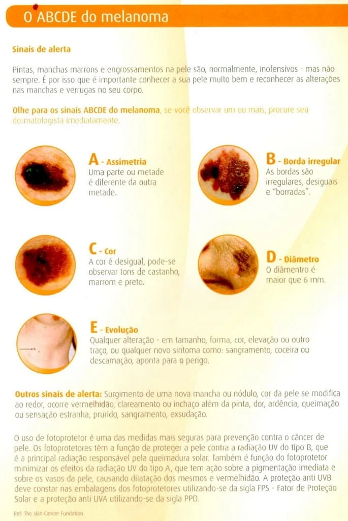 melanoma cancer de pele melanoma cancer de pele