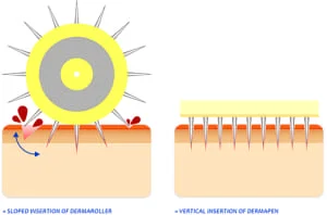 dermaroller