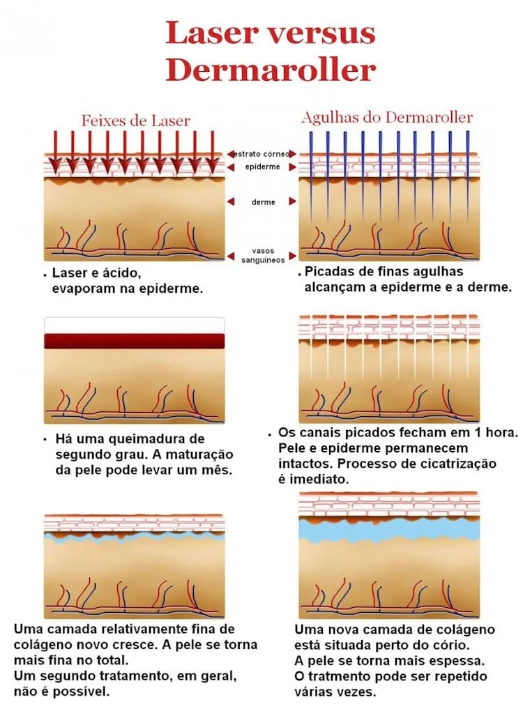microagulhameto e dermaroller-como-funciona com dermatologista