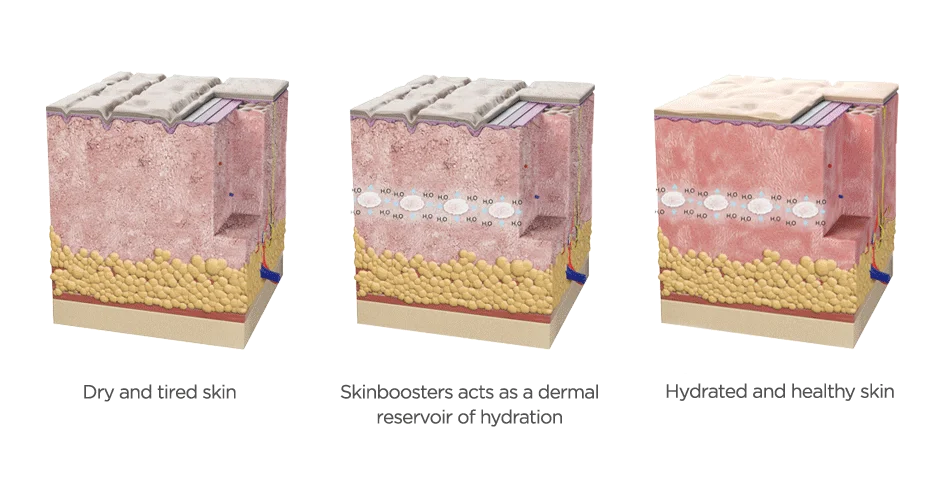 Skinbooster acido hialuronico restylane vital e restylane vital light