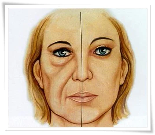 bigode chines preenchimento acido restylane volume juvederm sao paulo