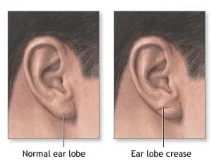 preenchimento de lobulo orelha com restylane e juvederm sao paulo