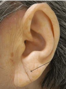 preenchimento de lobulo orelha com restylane e juvederm sao paulo osasco alphaville