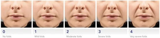 preenchimento de sulco com restylane e juvederm radiesse sculptra