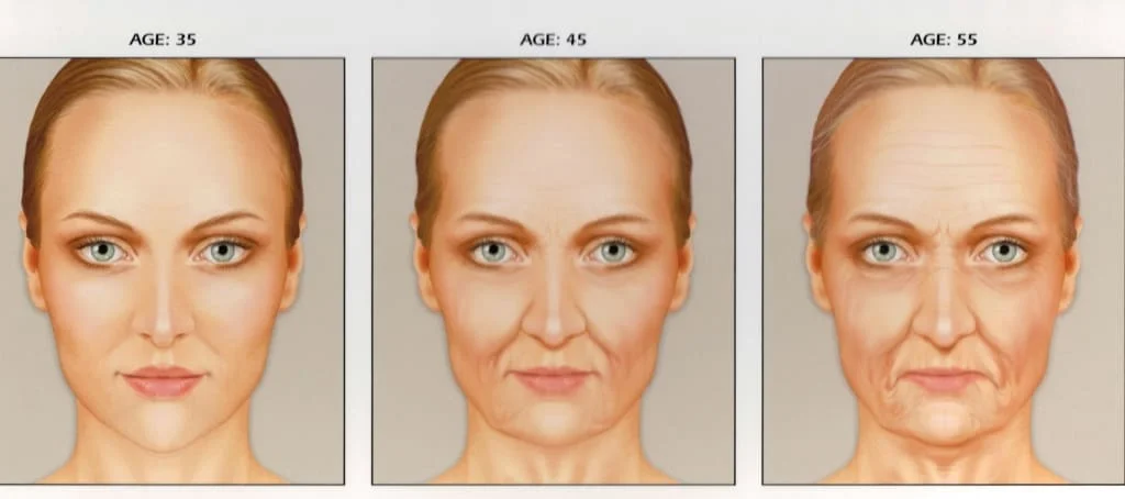Preenchimento maça do rosto o bochechas -Terço médio Preenchimento maça do rosto o bochechas -Terço médio