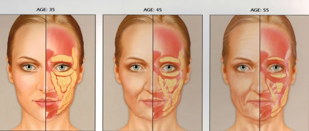 Preenchimento maça do rosto o bochechas -Terço médio preenchimento restylane e perlane radiesse e voluma sculptra face facial