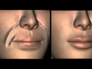 tratamento bigode chines preenchimento acido sao paulo