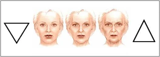 Preenchimento maça do rosto o bochechas -Terço médio triangulo da juventude - preenchimento restylane e perlane radiesse e voluma facial
