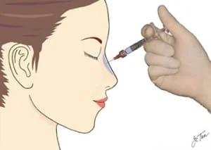 preenchimento de nariz acido hialuronico saopaulo