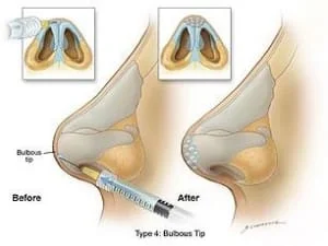 preenchimento de nariz acido hialuronico