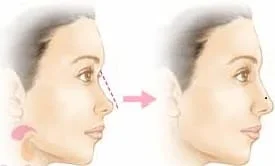 preenchimento de nariz acido hialuronico