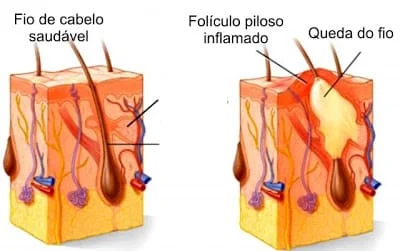 Tratamento da queda de cabelo e alopecia em sao paulo homem mulher