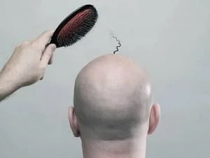 calvicie-masculina-dermatologista-saopaulo