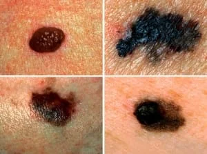 tratamento cancer de pele em sao paulo , cirurgia cancer de pele, melanoma tratamento