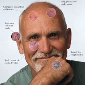 Tratamento câncer de pele com cirurgia em Sao Paulo e Osasco, com cremes, crioterapia ou cirurgia 