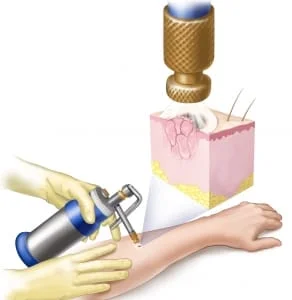 tratamento cancer de pele com cirurgia em Sao Paulo e Osasco com crioterapia