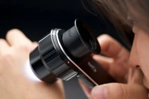 tratamento cancer de pele com cirurgia em Sao Paulo e Osasco dermatoscopia