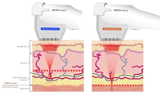 HIFU-tratamento com ulthera em sao paulo