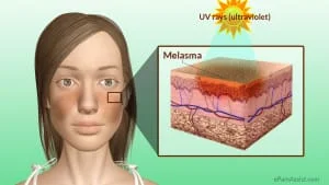 Melasma tratamento Laser roller sao paulo osasco alphaville