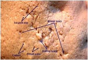 Tipos e tratamento de cicatriz de acne com dermatologista em Sao Paulo e Osasco Alphaville