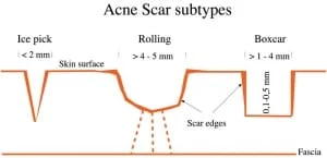 tipos e tratamento de cicatriz de acne SAO PAULO