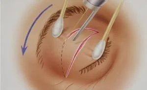 Especialista em cirurgia de Pálpebra - Blefaroplastia sao paulo osasco alphaville