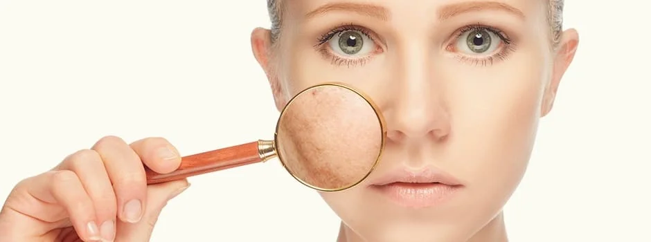 Melasma tratamento Laser derma roller sao paulo osasco alphaville