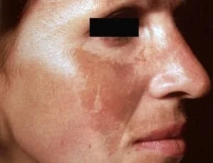 Melasma tratamento com peeling Laser roller sao paulo osasco alphaville