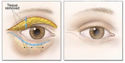 Cirurgia Plástica de Pálpebra especialista Sao Paulo Osasco Alphaville
