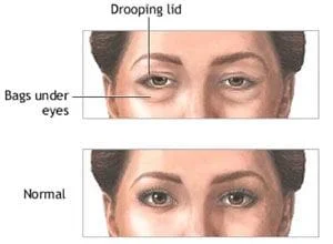 Cirurgia Plástica de Pálpebra especialista Sao Paulo Osasco