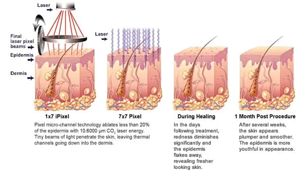 peeling a laser em sao paulo dermatologista estetica