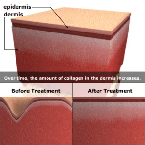 peeling a laser em sao paulo dermatologista