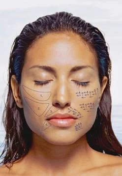 tratamento com sculptra em sao paulo jardim osasco alphaville dermatologista