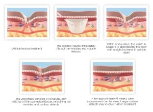 tratamento de sculptra em sao paulo jardim osasco alphaville dermatologista