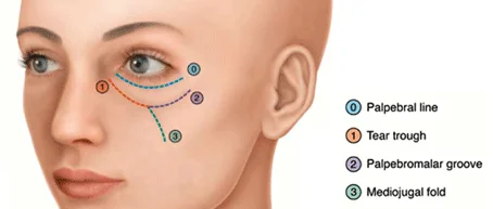 preenchimento de olheira especialista md codes