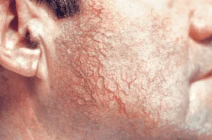 tratamento veias rosto