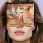 masseter hipertrofia