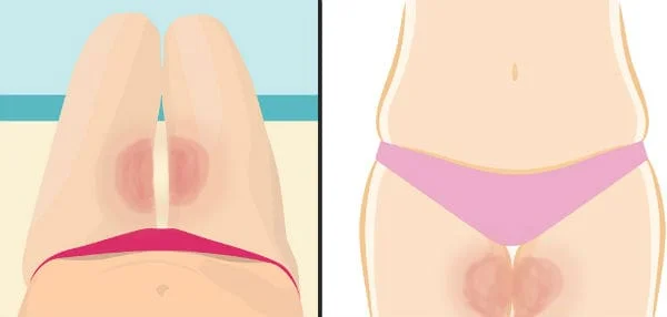 hiperidrose-coxa-genital