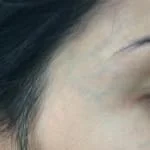 tratamento veias rosto