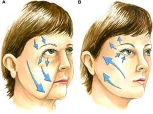 Preenchimento da maçã do rosto com Dermatologista